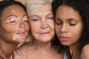 vitiligo micropigmentation